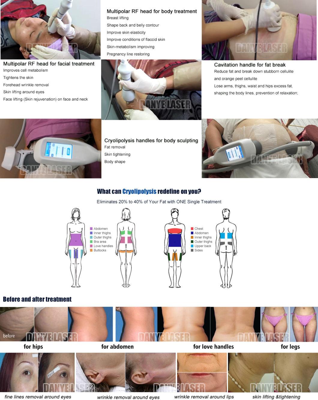 Cryo RF Vacuum Cavitation System Body Remodeling Equipment