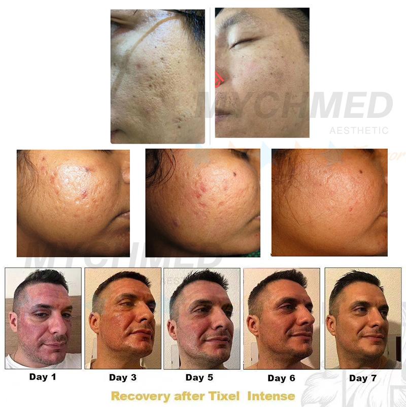 RF Pure Heat Acne Marks Treat Novoxei Tixei Facial Thermal Beauty Equipment