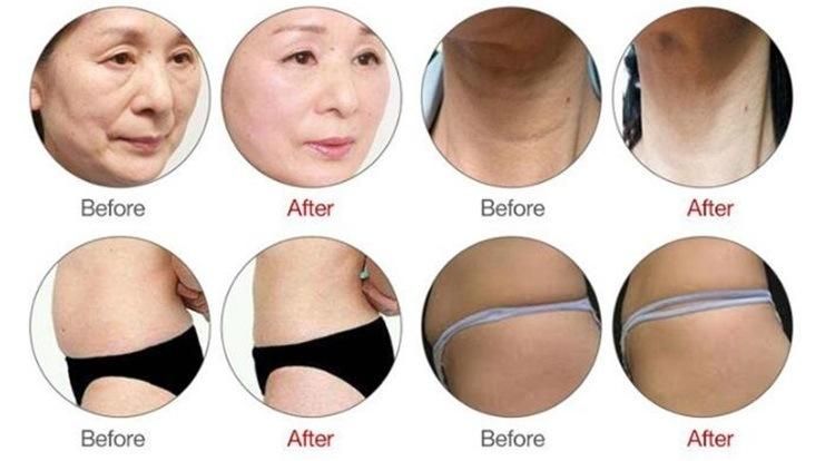 Multifunctional 4D Hifu Machine Skin Rejuvenation Skin Beauty Equipment