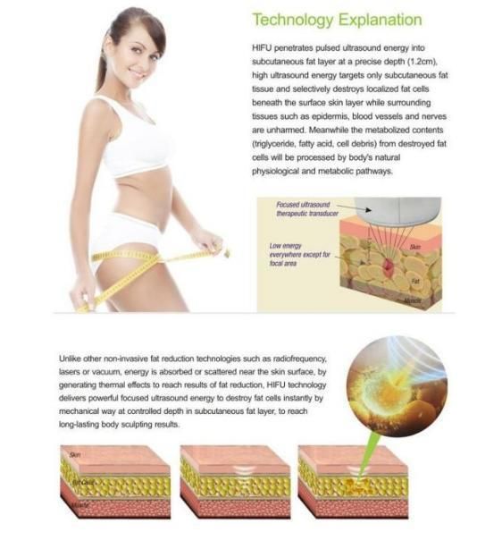 High Intensity Focused Ultrasound Machine/3D Hifu Slimming Equipment