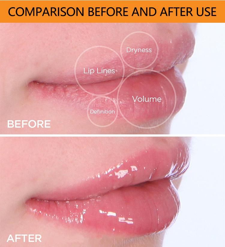 Lips Boosting Roller System Serum Stimulates Collagen Production & Skin Regeneration