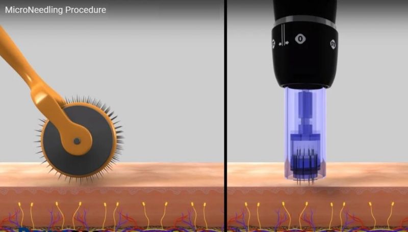 Non Crosslinked Hyaluronic Acid Mesotherapy Treatment Microneedle Serum