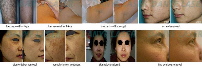 Portable RF IPL Shr Permanent Hair Removal Laser Pigmentation Removal Multi Function Beauty Machine