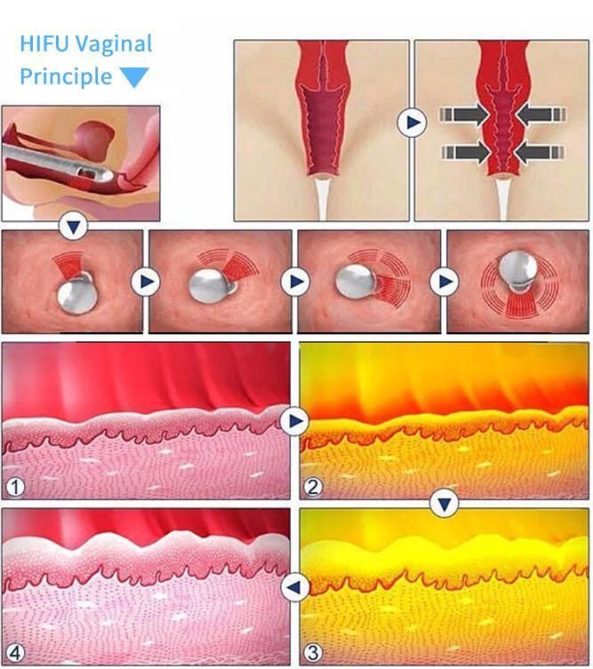 V-Skin Tightening Wrinkle Remover Anti-Puffiness Provide The Energy for Hifu
