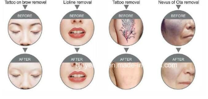 Super ND YAG Laser Tattoo Removal Equipment 1320nm 563nm 1064nm Skin Whitening