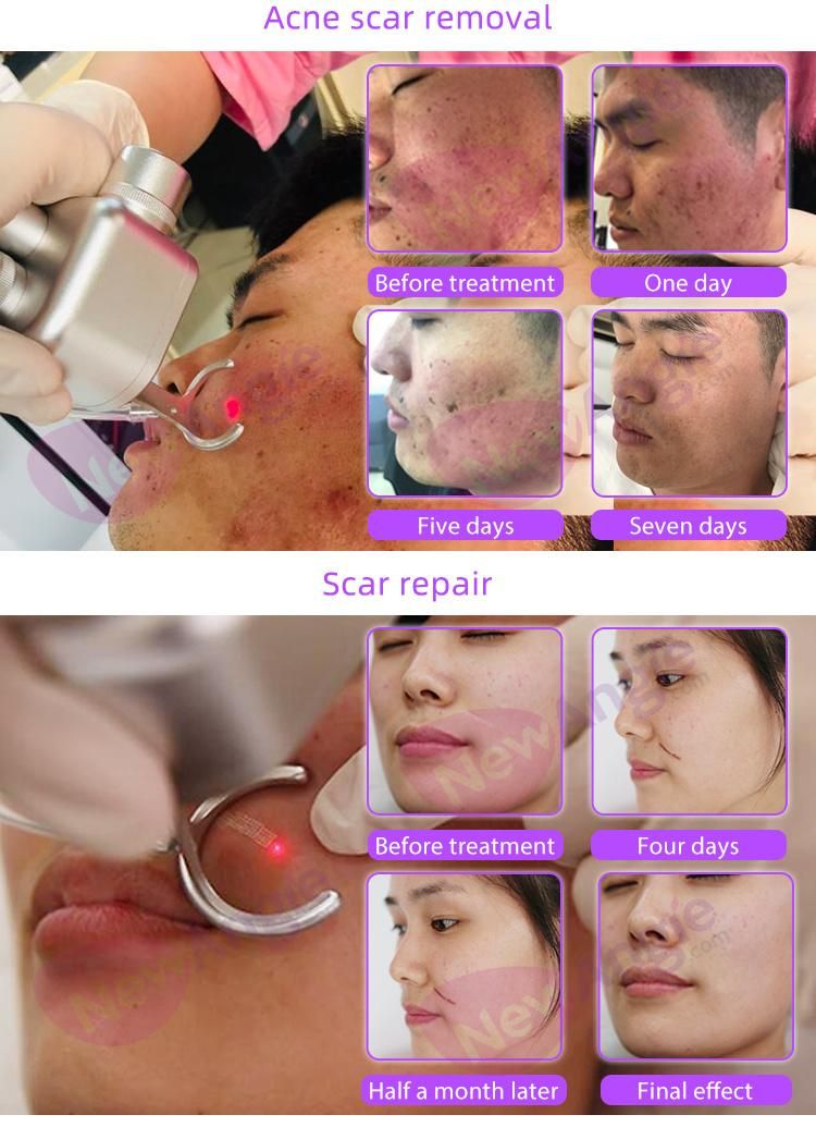 Newangie Popular Selling Beauty Equipment Skin Health Care Fractional CO2 Laser Skin Resurfacing Machine