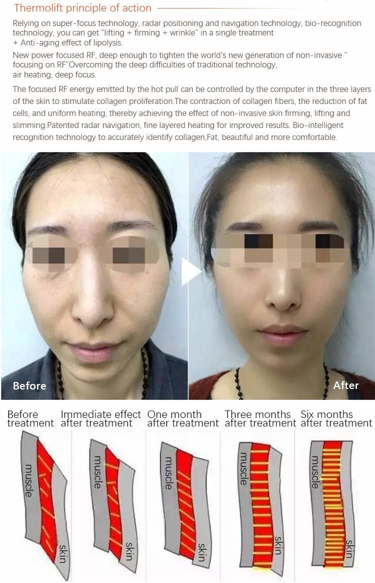 2019 Newest Professional Focused 40.68Hz RF Thermolift Face Lifting for Beauty Clinic and SPA