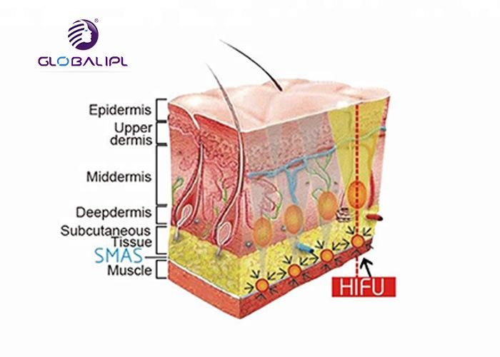 New Technology Wrikle Removal Machine Hifu Portable