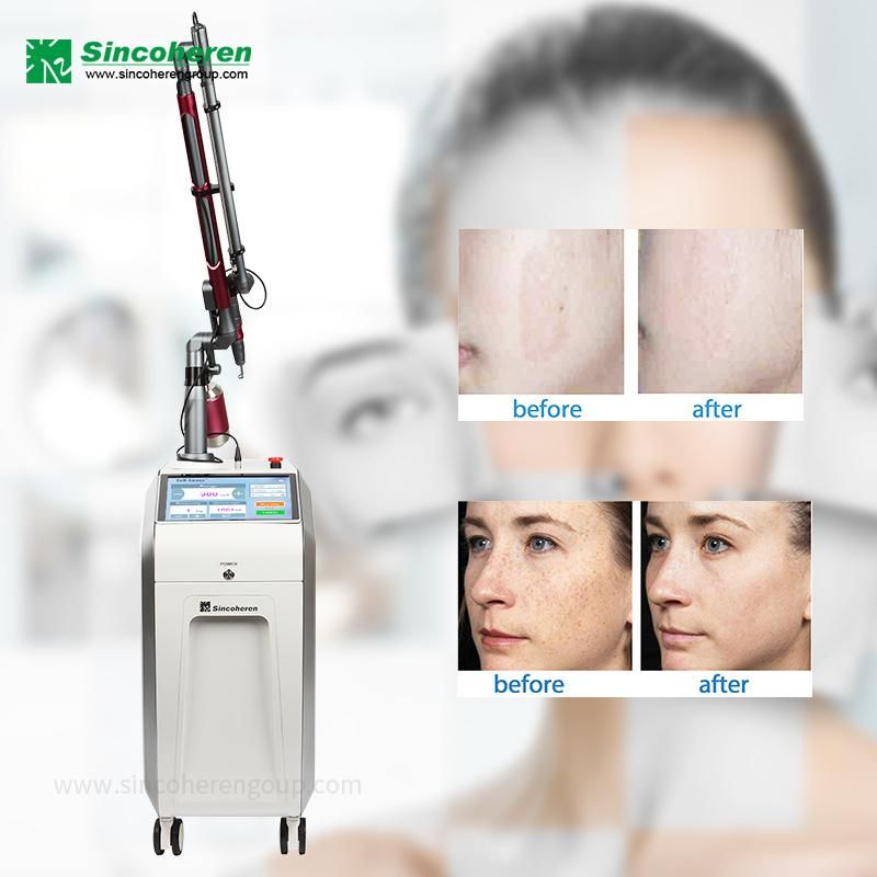 Professional Q Switched ND YAG 1064nm 532nm Picosecond Laser Tattoo Removal Machine