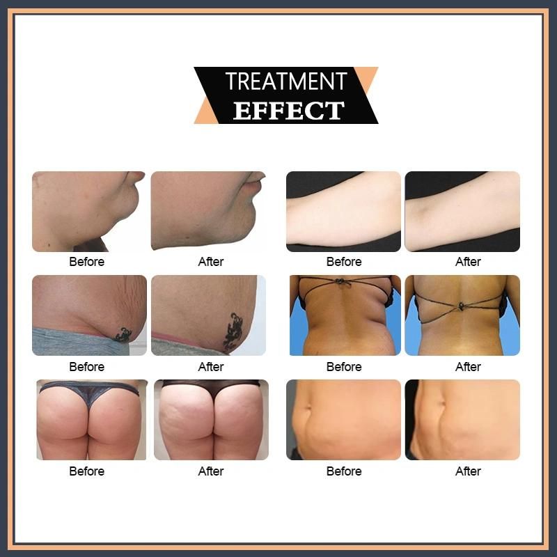 Beijing Sunrise 6D Laser Cellulite Reduction Body Slimming No Invasive Weight Loss Lipo Laser Non-Thermal & No Pain Safe and Reliable Laser Fat Removal Slimming
