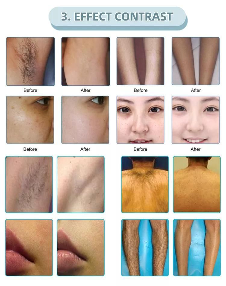 The Latest Portable IPL Painless Permanent Laser Hair Removal Tender Skin Lpl Hair Removal Machine Diode Laser