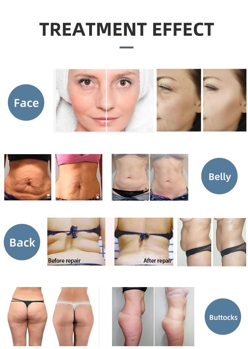 Cet Ret 448kHz Tech Tecar Therapy for Skin Tightening