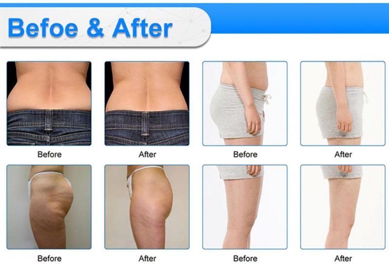 So CE Approved Non Pain No Downtime Long Lasting Vacuum 360degree Coolplas Burn Fat Fat Reduction