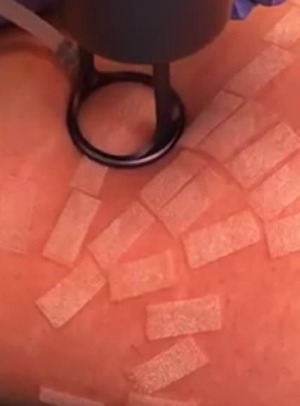 Medical Surgical CE Acne Scar Removal CO2/Hifu Vaginal Rejuvenation Pixel CO2 Fractional Laser