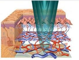 Fractional CO2 Laser Ultrapulse