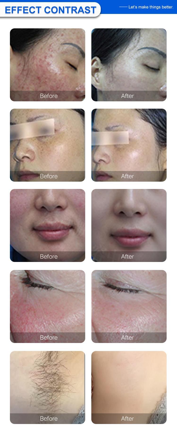 Intense Pulsed Light Hair Removal System Skin Rejuvenation IPL