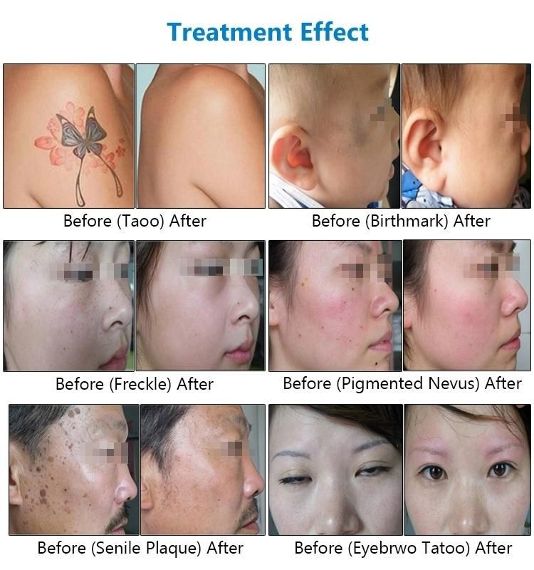 Multifunctional Beauty Equipment ND YAG Laser Tattoo Removal Dermis Spot Pigmentations Removal
