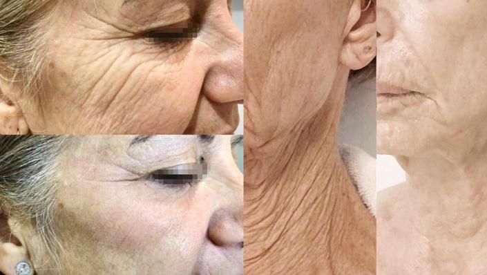 12 Lines in Maxine 4D Hifu for Face Lifting, Wrinkles Removal, Fat Reduction