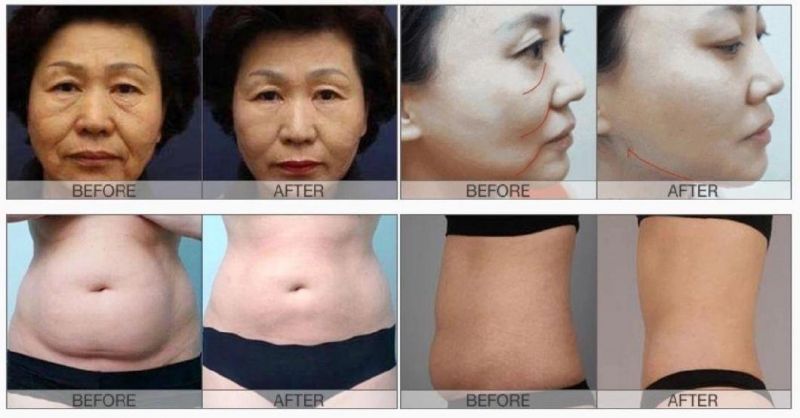 Best Slimming Effect Liposonix Hifu Beauty Machine for Cellulite Removal Anti-Aging