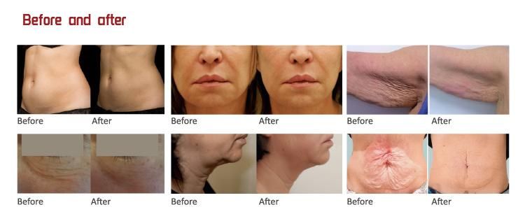 Hifu Skin Tightening Newest Face Lift Device Wrinkle Removal Hifu