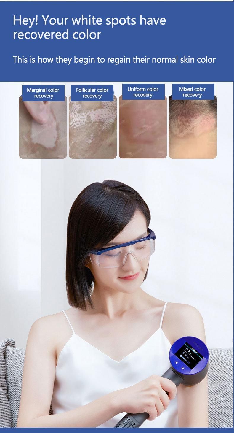 LED UVB Phototherapy Narrow 308 Nm UV Phototherapy Lamp UVB Light Therapy Psoriasis for Vitiligo