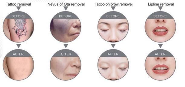 Q Switched ND YAG Laser Tattoo Removal Skin Pigmentation