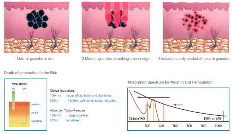 Professional Tattoo Removal Picosecond 532nm 1064nm Laser Pigment Removal Tattoo Removal for Clinic SPA Salon
