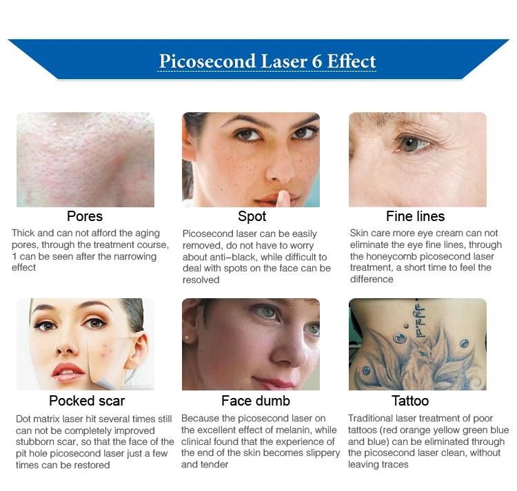 Pigmentation/Tattoo/Acne Removal New Pico Laser Removal Tattoo for Clinic and Salon