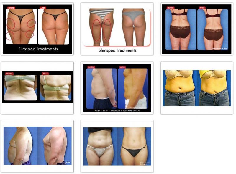 Ce, ISO Approved Ultrasoundic RF+Cavitation Slimming System