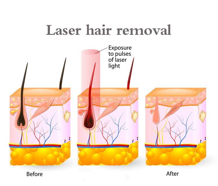 Permanent Hair Removal Microchannel Diode Laser 808nm Machine for All Skin Color