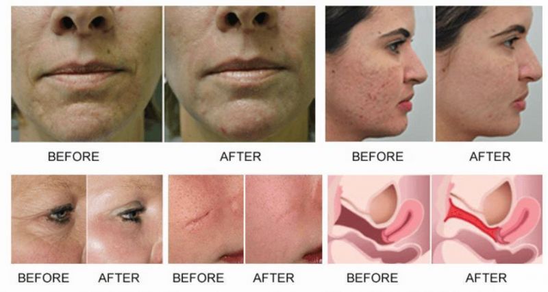 CO2 Fractional Laser Machine Beauty Equipment Professional CO2 Laser Skin CO2 Fractional Laser Machine Skin Resurfacing