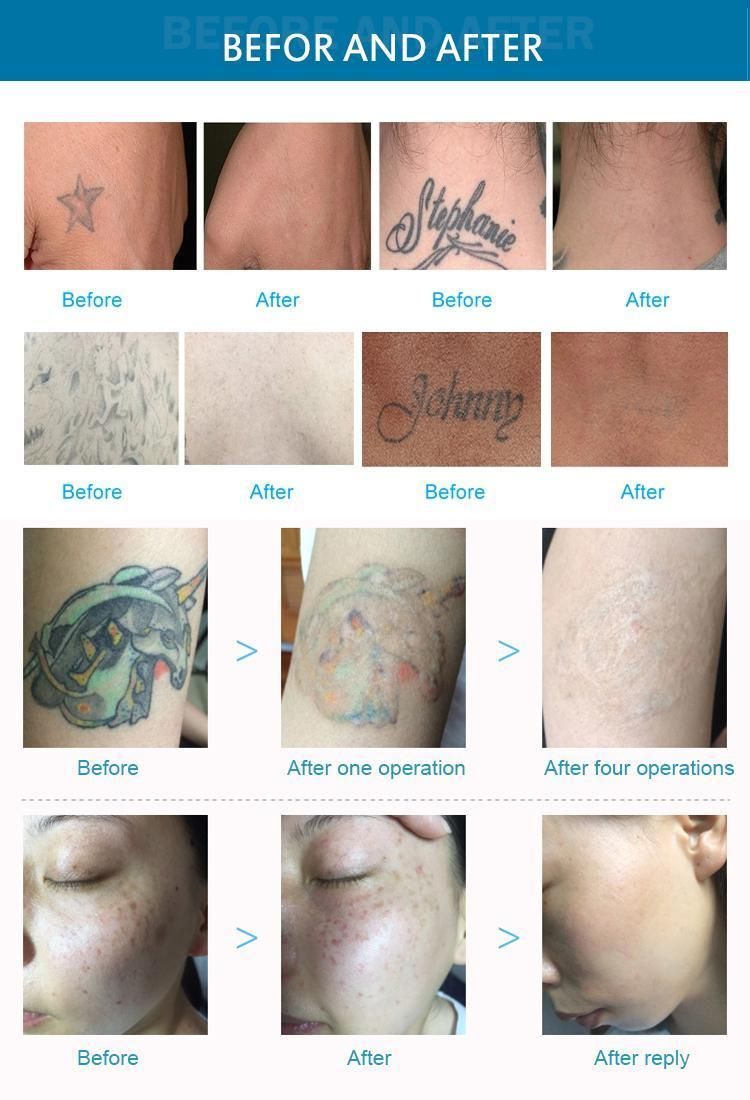 ND YAG Laser Tattoo Removal Laser Skin Care Medical Equipment