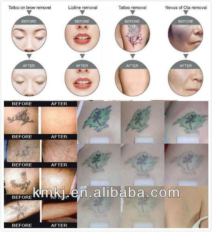 Best Professional High Power ND YAG Laser Tattoo Removal