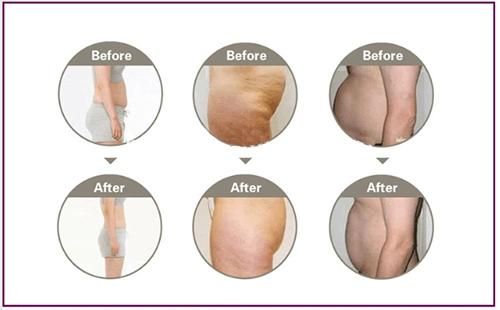 Freeze Fat Cellulite Removal Machine Criolipolisis