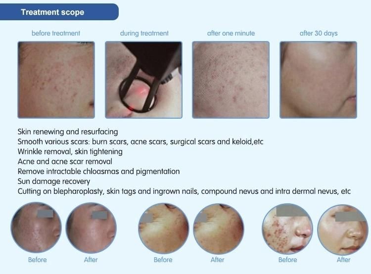 Fractional Scar Removal Acne Treatment CO2 Fotona Laser Medical