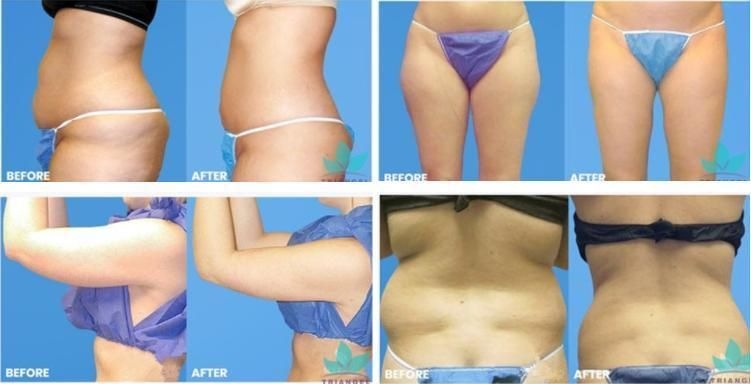 Skin Resurfacing Diode Laser 980+1470nm Machine Liposuction Weight Lose Device