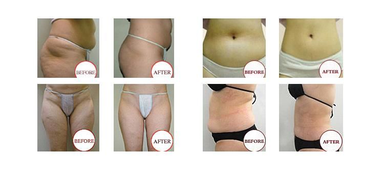 Fat Freezing Cryo Cryolipolysis Slimming Beauty Salon Equipment Ce Approval