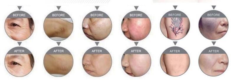 4 in 1 Beauty Machine Popupar in Clinic