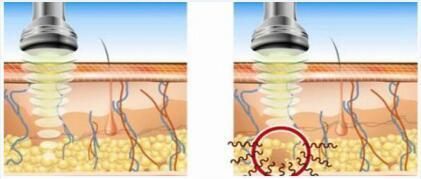 Ultrasonic Cavitation Machine with Roller Massage Product