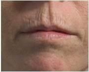 Monopolar RF Face Lifting Eye Wrinkle Removal Forhead Wrinkle Removal The Return to Youth Look