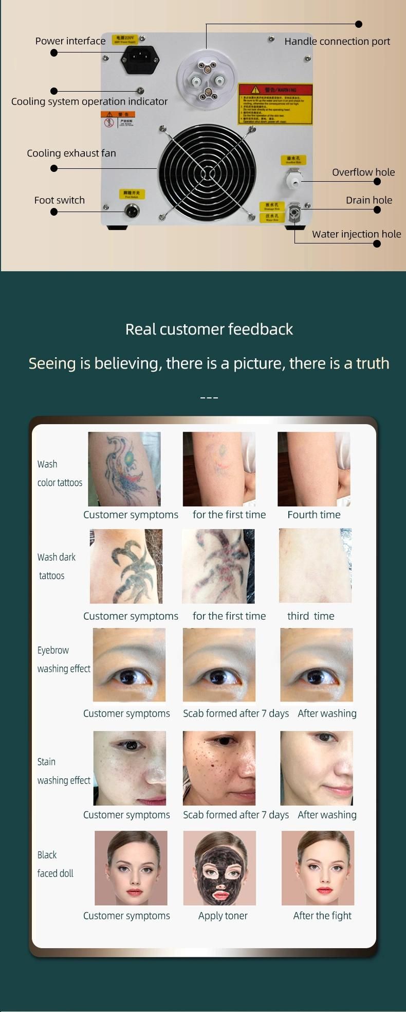 Laser Tattoo Removal Pigment Spots Remove Spots Rejuvenation Eyebrow Washing