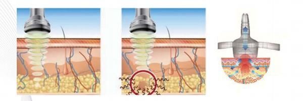 Portable Multifunction Cavitation Effect Ultrasound for Body Slimming