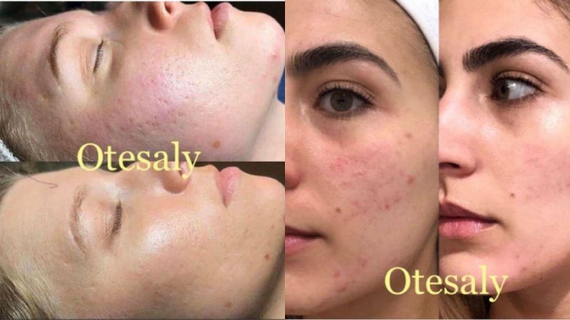 Best Price Mesotherapy Solution Skin Rejuvenation Solution Skin Repairing Meso Acido Hialuronico Solution