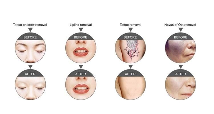 Tattoo and Pigment Removal Skin Whitening