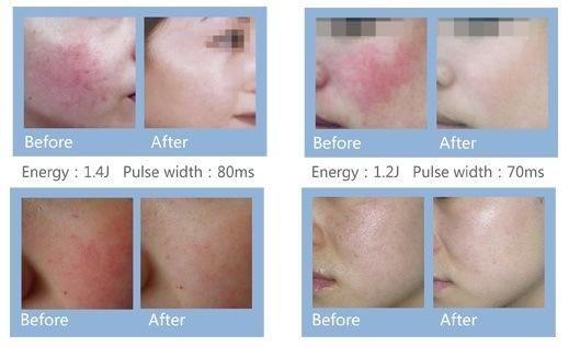 Vascular Removal Spider Vein Removal 980nm Medical Diode Laser