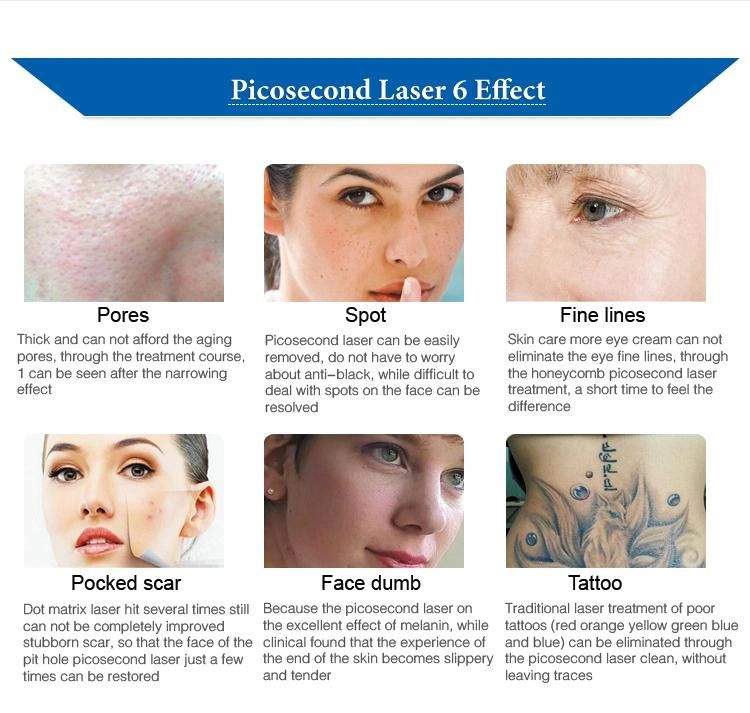 Strong Power Picosur Laser Tattoo Removal Picosecond Laser for Sale