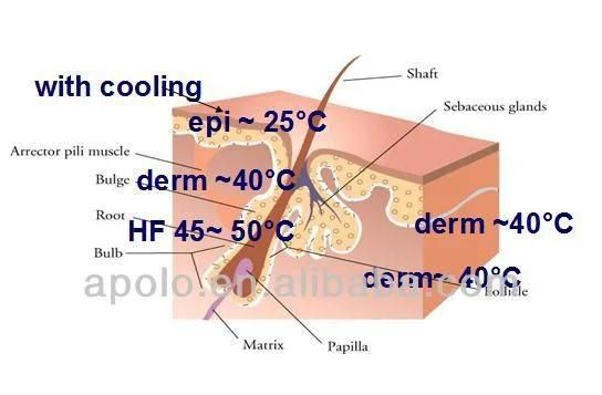 810nm laser diode laser epilation laser HS 811 machine by shanghai med apolo medical