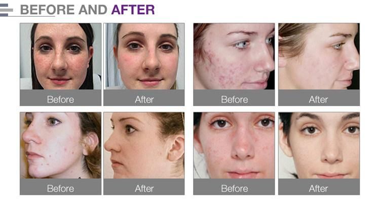 Skin Rejuvenation Whitening Facial Mask PDT LED Light Therapy