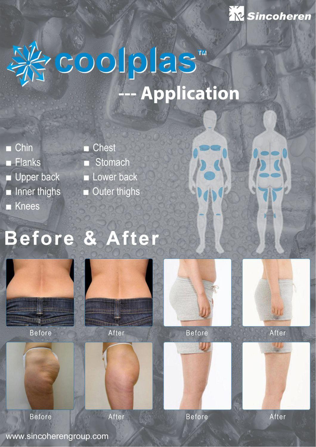 Beijing Sincoheren Factory Price Cellulite Reduction and Fat Reduction Coolplas for Body Shaping Fat Freezing (J)