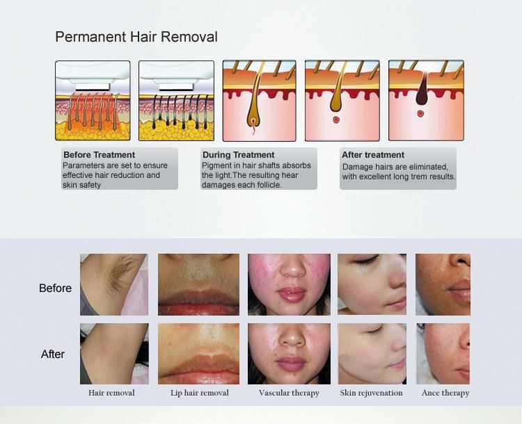 Powerful Hair Removal Vertical Opt Laser Machine